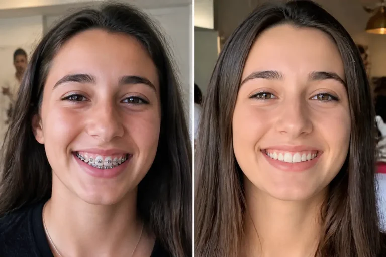 Deux photos d'une jeune fille montrant l'effet avant-après de l'appareil dentaire