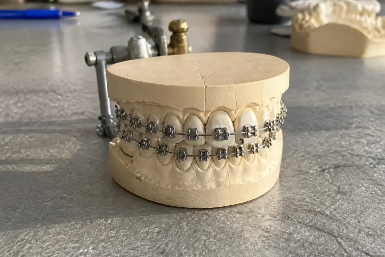 Modèle dentaire avec appareil à bagues en métal sur table de laboratoire dentaire
