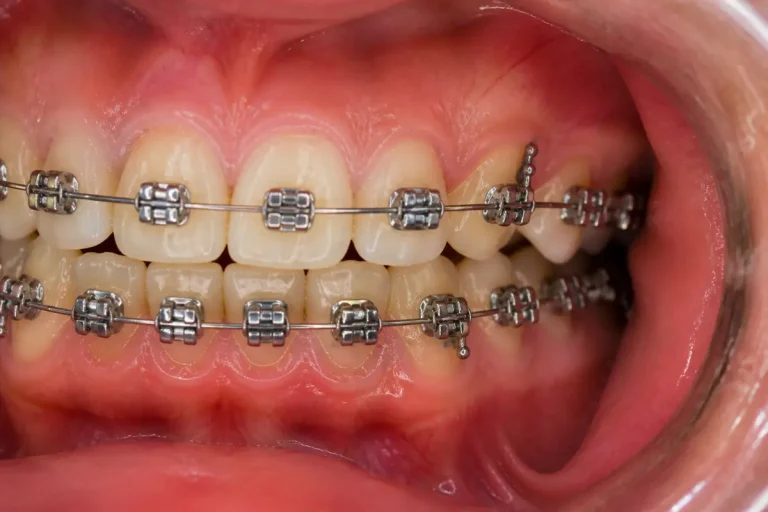Gros plan sur des dents avec appareil dentaire en métal ajusté et visible