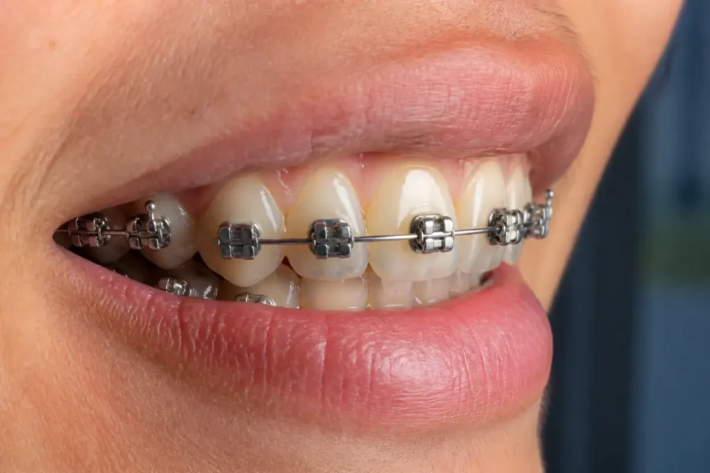 Sourire avec appareil orthodontique en bague dentaire en métal, gros plan.