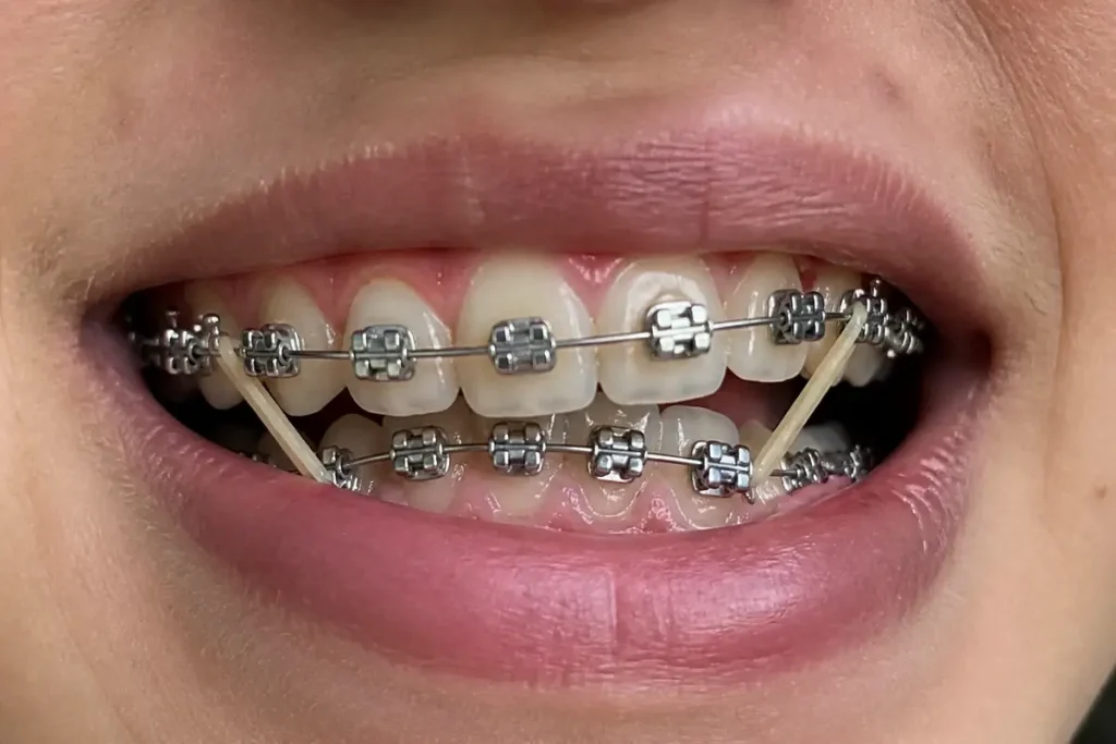 Sourire avec appareil dentaire et élastique pour bague dentaire fixée sur les dents