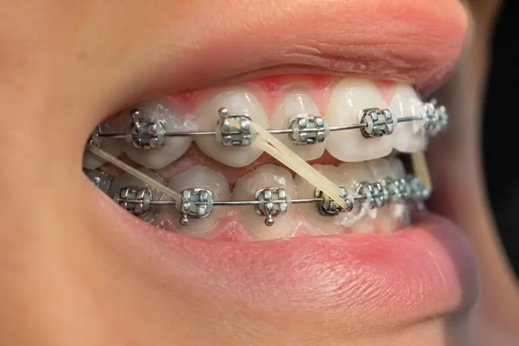 Gros plan sur des dents avec un appareil et élastiques en orthodontie