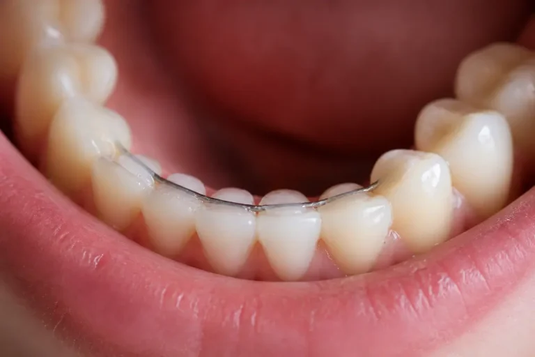 Dents inférieures avec fils de contention pour alignement orthodontique et stabilité dentaire