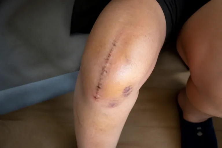 Genou cicatrisé et contusionné après une opération de prothèse avec douleur intense.