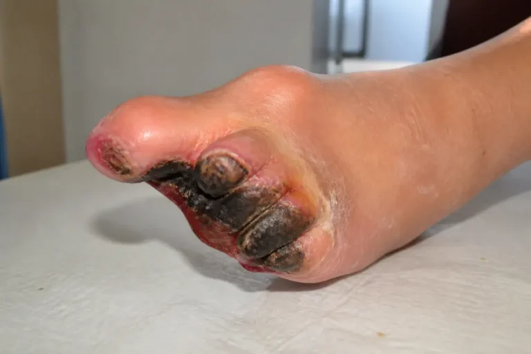 Pied atteint de nécrose, montrant une décoloration noire et des tissus endommagés