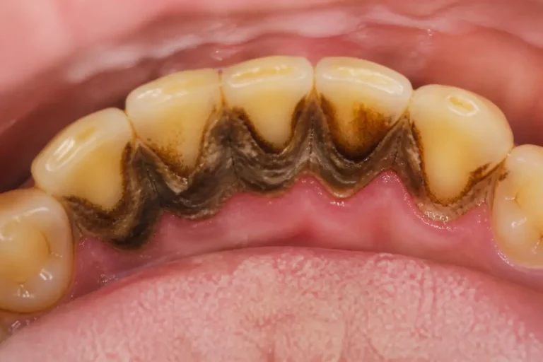 Dents avec accumulation sévère de tartre noir sur la gencive inférieure.
